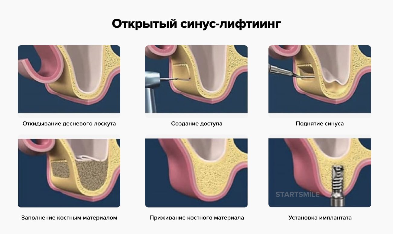 Синуслифтинг открытый