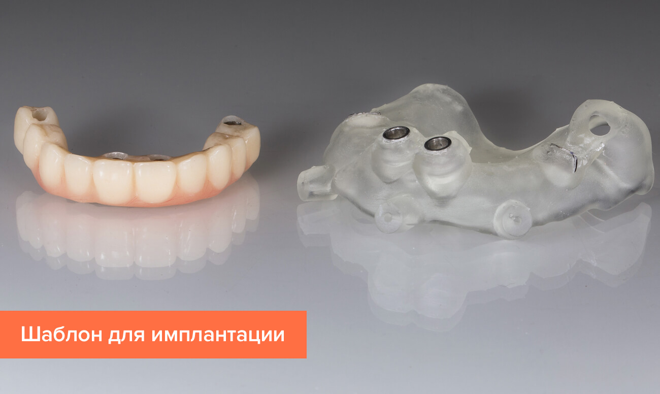 хирургический шаблон для имплантации что это такое. hirurgicheskiy shablon dlya implantacii. хирургический шаблон для имплантации что это такое фото. хирургический шаблон для имплантации что это такое-hirurgicheskiy shablon dlya implantacii. картинка хирургический шаблон для имплантации что это такое. картинка hirurgicheskiy shablon dlya implantacii. Имплантация зубов как одно из самых передовых направлений в стоматологии становится все более стабильным и безопасным методом ортопедического лечения. Если раньше с ним связывали множество рисков отторжения имплантов, травматизма и длительности многоэтапных процедур, то сегодня большинство из этих проблем сводятся к нулю, в том числе благодаря применению хирургических шаблонов.