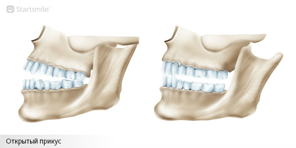 Открытый прикус