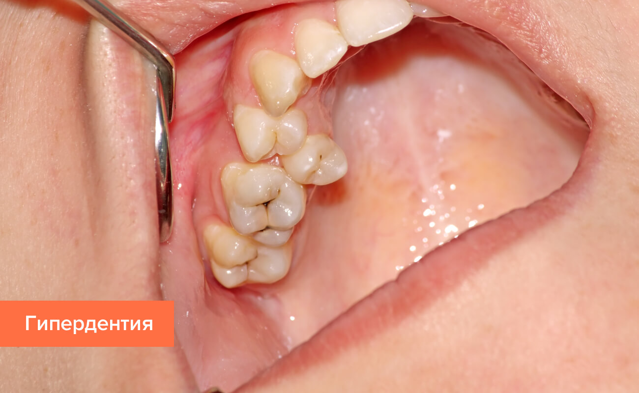Фото гипердентии коренных зубов у ребенка