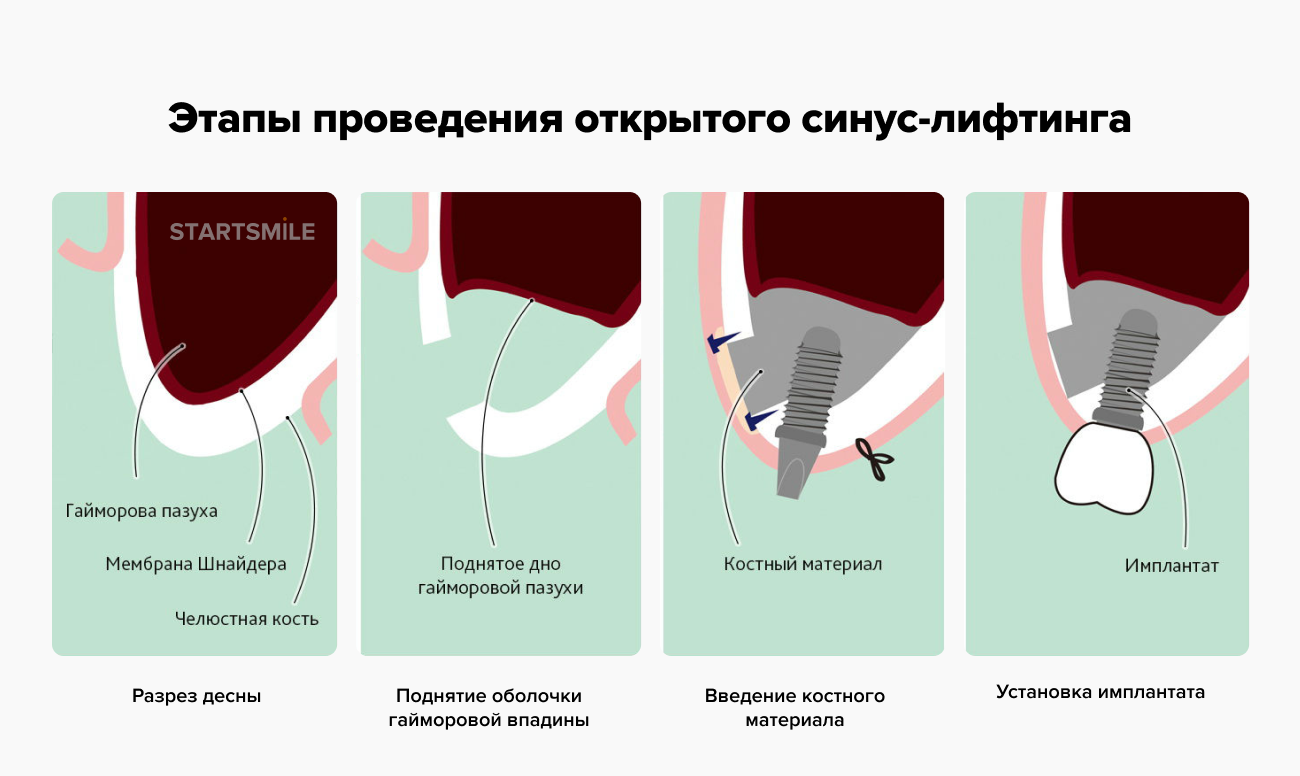 Этапы открытого синус-лифтинга Этапы проведения процедуры открытого синус-лифтинга в картинках