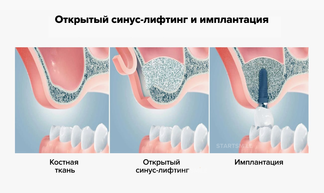 Открытый синус-лифтинг и имплантация Открытый синус-лифтинг и имплантация в картинках.