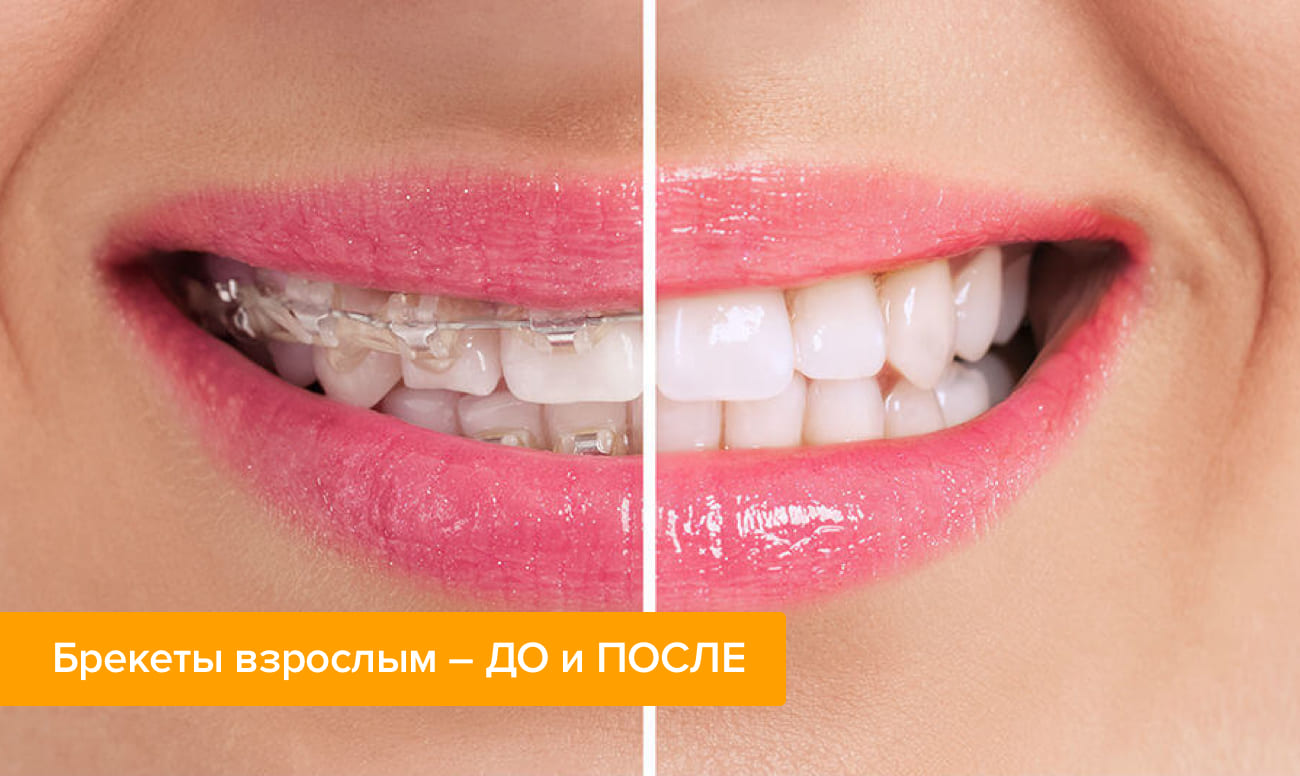 Фото зубов до и после лечения на брекетах