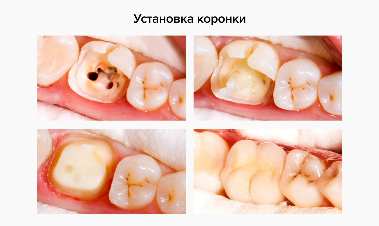 Фото этапов установки коронок на зубы