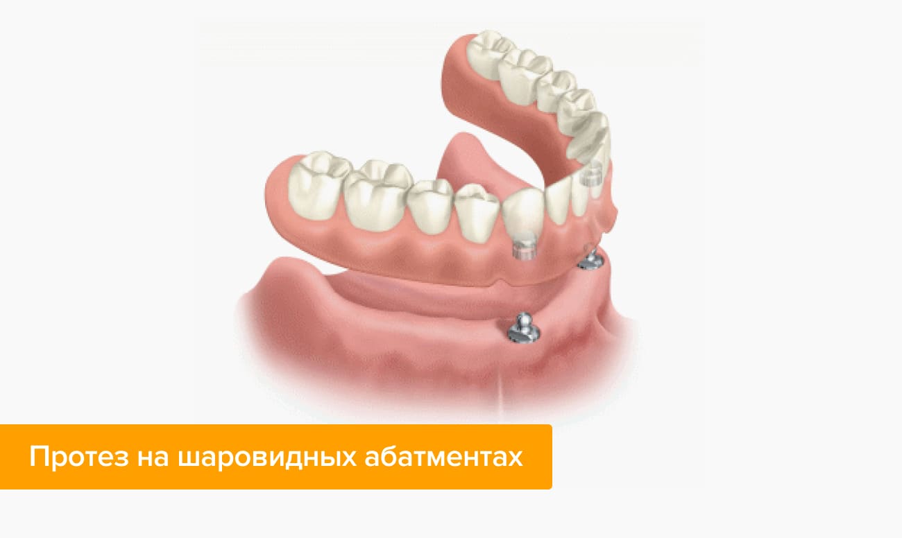 Шаровидное крепление съемного протеза на имплантах Шаровидное крепление съемного протеза на имплантах в картинках