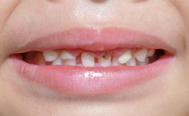 Фото поверхностного кариеса молочных зубов