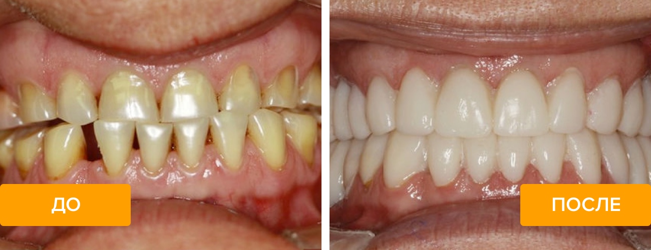 Фото пациента до и после имплантации зубов