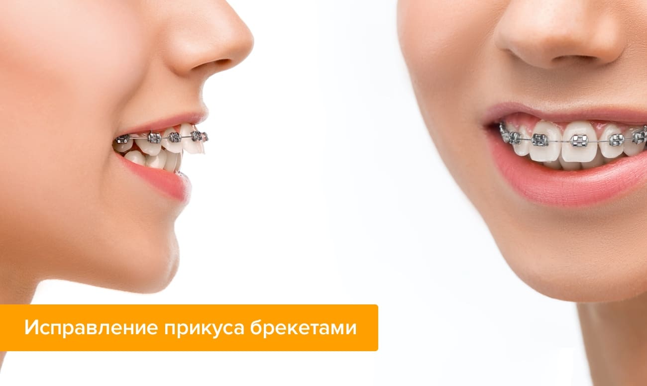 Фото девушки с брекетами на зубах