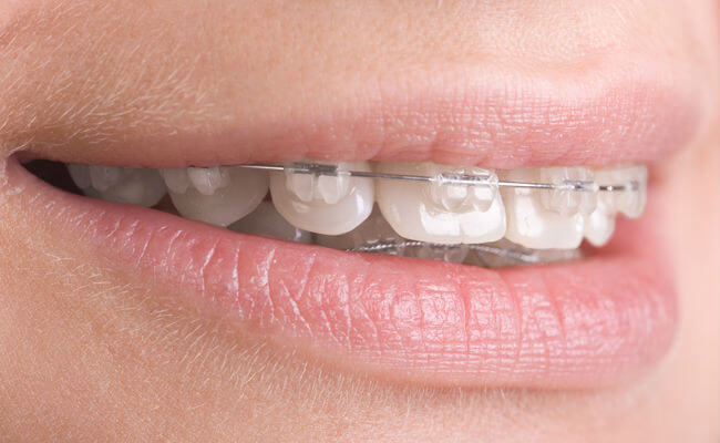 Фото эстетических брекетов из пластика на зубах
