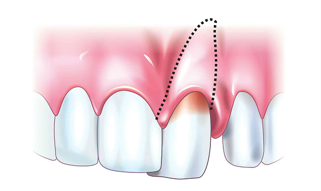 Вывих зуба