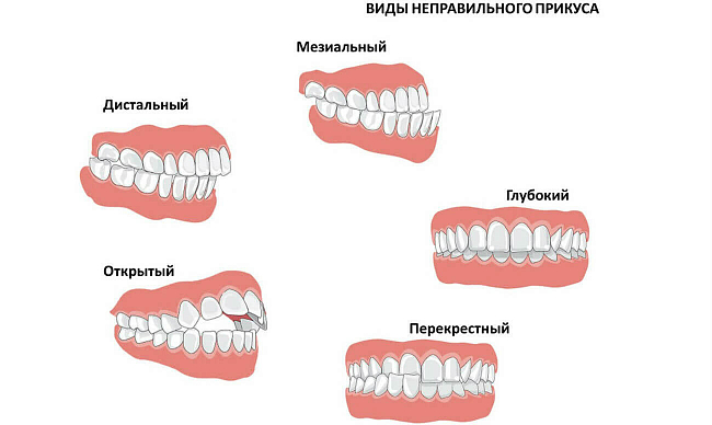 Аномалии прикуса