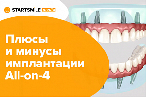 Плюсы и минусы имплантации по методу «Все на 4-х»