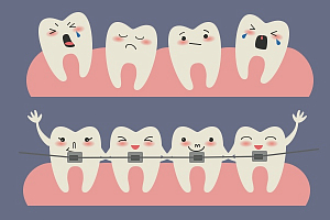 Брекеты для детей