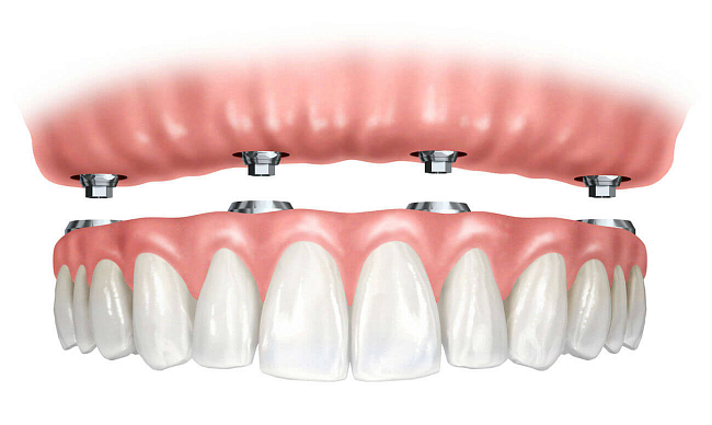 Условно-съемный протез на имплантах