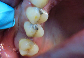 Восстановление зубов эстетическими пломбами