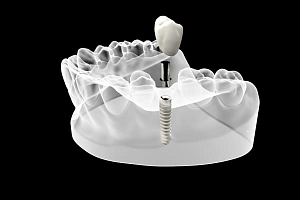 Импланты на жевательные зубы