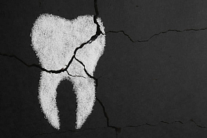 Трещины на зубах — причины, последствия, как лечить
