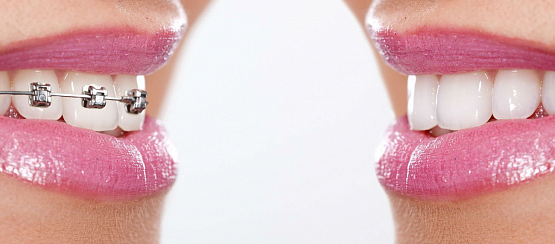 Капы для выравнивания зубов