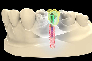 Дентальные имплантаты получат инновационное покрытие