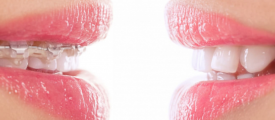 Элайнеры или брекеты — что лучше?