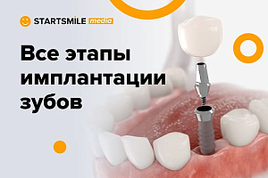 Этапы установки зубных имплантов