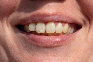 Белые пятна на зубах: причины и как их убрать?