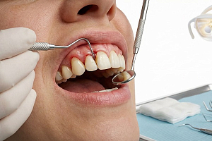 Генерализованный пародонтит