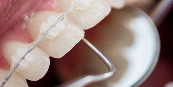 Сколько носят брекеты?