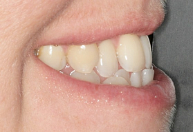 Восстановление окклюзии капами Invisalign