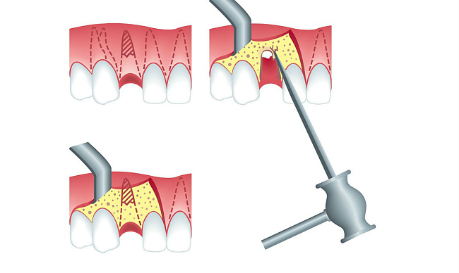 Ампутация корня зуба