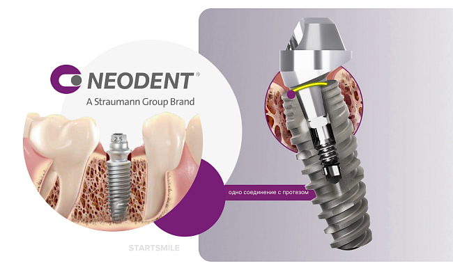 Импланты «Неодент»