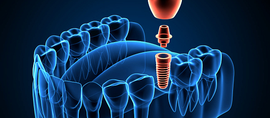 Имплантация без костной пластики