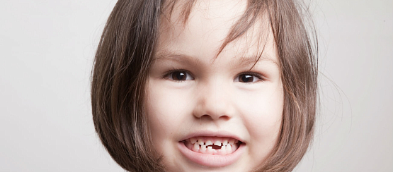 Кариес молочных зубов