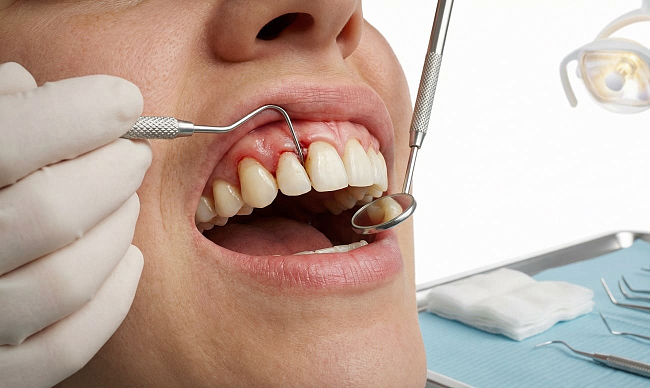 Генерализованный пародонтит