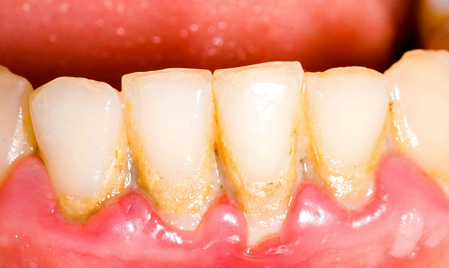 Отложения зубные