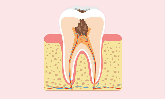 Кариес глубокий