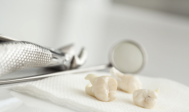 Сухая лунка после удаления зуба — симптомы и лечение