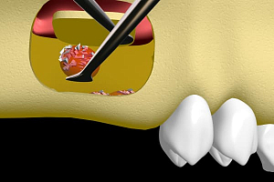 Имплантация зубов после синус-лифтинга