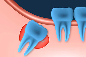 Киста зуба мудрости