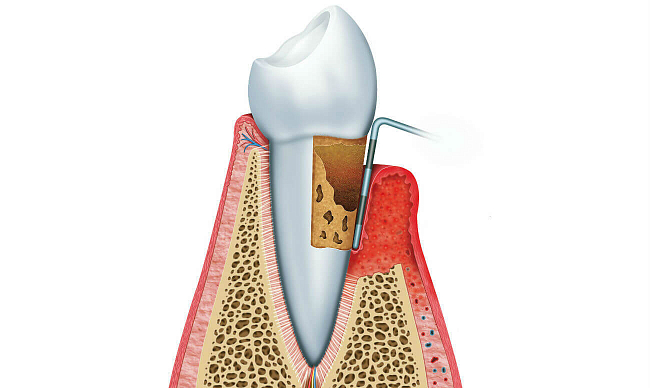 Кюретаж пародонтальных карманов