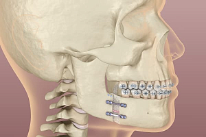 Исправление прикуса хирургическим путем