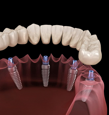 Имплантация челюсти All-on-4 с несъёмным протезом 290 000 руб.