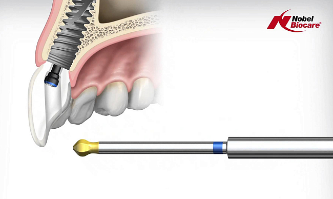 Импланты Nobel Biocare
