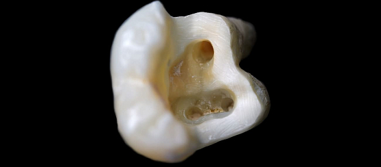 Удаление нерва зуба