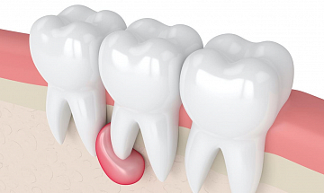 Киста на зубе – лечение или удаление?