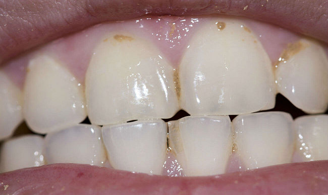 Деминерализация зубов — что это такое, показания и противопоказания, лечение деминерализации эмали