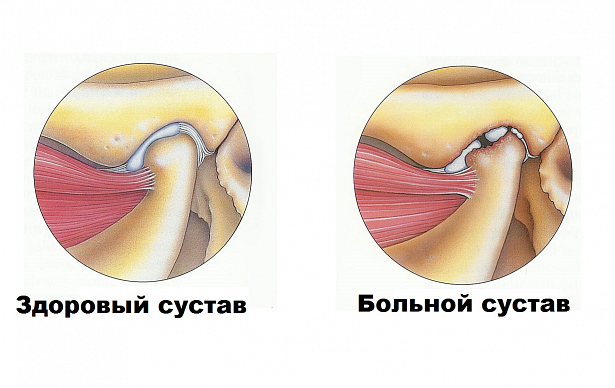 Артроз челюсти