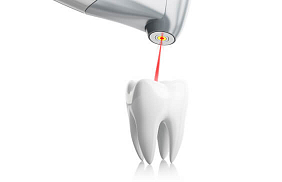 Лечение кисты зуба лазером