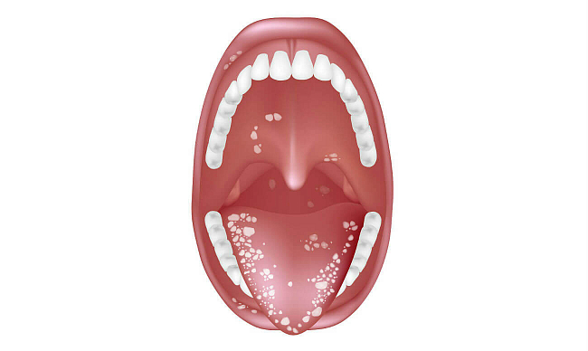 Молочница полости рта