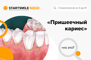 Кариес в области шейки зуба: когда начинать беспокоиться?